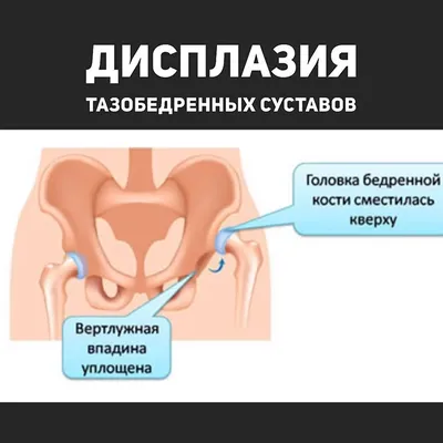 Дисплазия тазобедренного сустава: причины и лечение болей в клинике  остеопатии