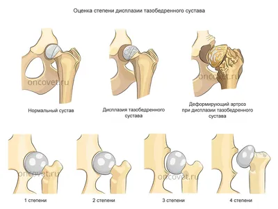 Дисплазия у грудничка. — 7 ответов