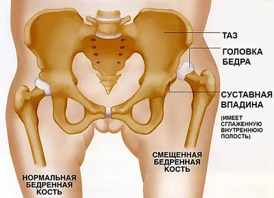 Что такое дисплазия тазобедренных суставов у детей, кто в группе риска, и  чем может повредить рюкзак-переноска — Полезные статьи