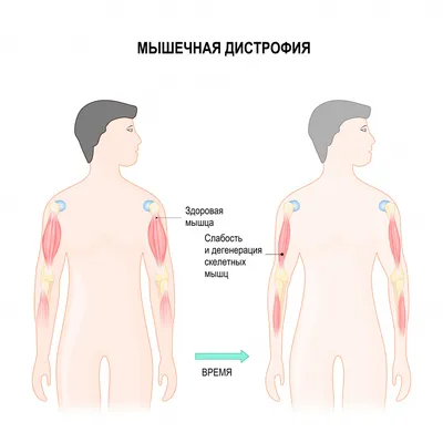 Мышечная дистрофия, или миодистрофия - причины появления, симптомы  заболевания, диагностика и способы лечения