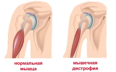 Боль Мышечная Дистрофия — стоковые фотографии и другие картинки Мышечная  дистрофия - Мышечная дистрофия, Атрофия, Грусть - iStock