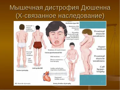 Мышечная дистрофия человека с выступанием живота Стоковое Фото -  изображение насчитывающей гандикап, бекона: 179198148