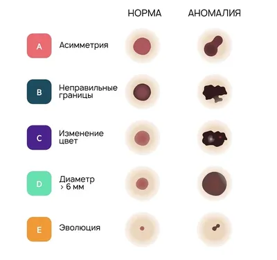 Меланома кожи: фото, стадии, симптомы. Лечение меланомы, диагностика