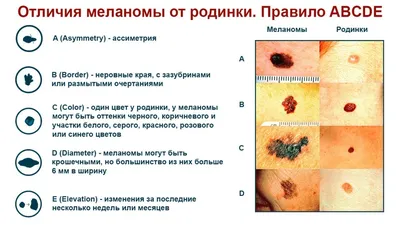 Меланома - Симптомы, причины, способы лечения|ROSH