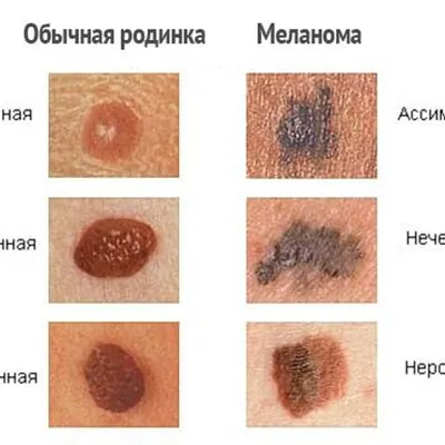 Рак кожи: симптомы, как выглядит, признаки, стадии, лечение