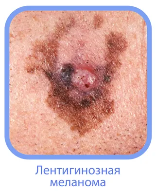 Как отличить родинку от меланомы и можно ли удалять родинки на коже - 8  июня 2023 - v1.ru