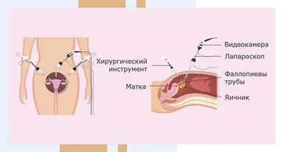 Доброкачественные опухоли яичников - причины, симптомы, диагностика и  лечение