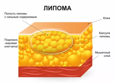 Диагностика и лечение новообразований кожи и подкожной клетчатки в  Краснодаре в клинике УРО-ПРО