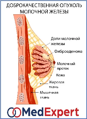 ОПУХОЛЬ МОЛОЧНОЙ ЖЕЛЕЗЫ | MED Expert