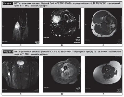 Применение магнитно-резонансной томографии в диагностике опухолей мягких  тканей