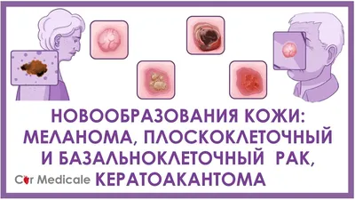 Доброкачественные опухоли головного мозга: симптомы и лечение хондром,  менингиом и опухолей мозга других типов