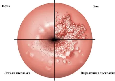 Доброкачественные опухоли мягких тканей фото