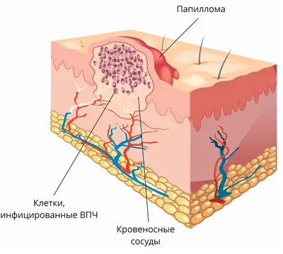 Лечение папиллом, бородавок