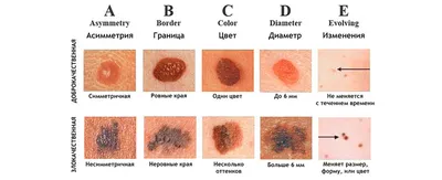 Опасны ли родинки — блог медицинского центра ОН Клиник