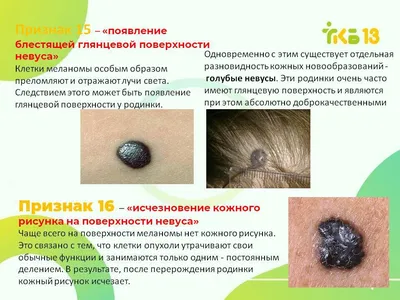 rafailonline - Безопасные #родинки. Имеющим на коже... | Facebook