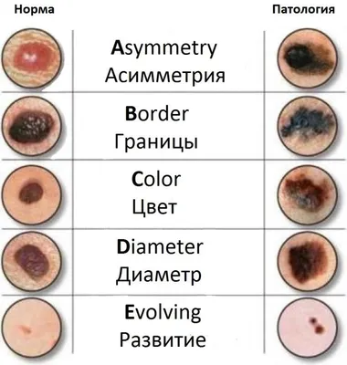 Какие «родинки» опасны?