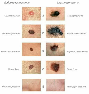 Раз — и в меланомы. Почему многим нельзя загорать и какие родинки опасны? |  Здоровая жизнь | Здоровье | АиФ Аргументы и факты в Беларуси
