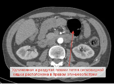 Ленивый\" кишечник. Долихосигма. Почему кишечник - вялый? | Система доктора  Соколинского. Видео. Исследования | Дзен