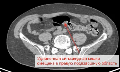 🥼©️Surgery_pro: Лапароскопическая резекция сигмовидной кишки (Lap.  sigmoidectomy). *** 🎓 Долихосигма — порок развития сигмовидной кишки,... |  By PhD. Dr. Magomedov S.M. | Facebook