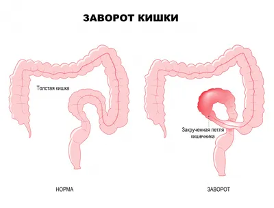 Ленивый\" кишечник. Долихосигма. Почему кишечник - вялый? | Система доктора  Соколинского. Видео. Исследования | Дзен