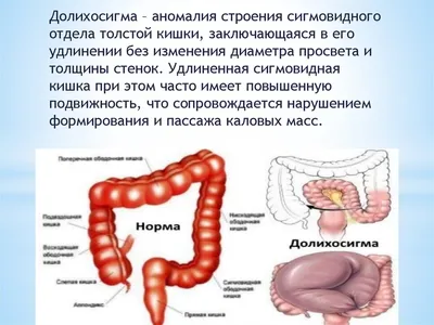 Долихосигма❱ операція ціна в Києві — Діагностика та лікування