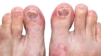 ☆ Complete cure the fungus between the toes. The drugs and folk remedies. -  YouTube