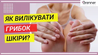 Микоз кожи стоп, ногтей, головы, рук | Лечение микоза у ребенка и взрослого  в Клинике подологии Полёт в Москве