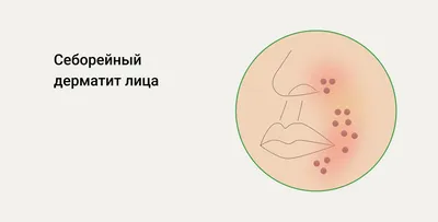 Грибок кожи, ногтей, складок | Центр подологии и остеопатии Татьяны Красюк