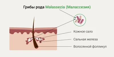 Лечение грибка кожи: как избавиться и чем лечить грибок кожи?