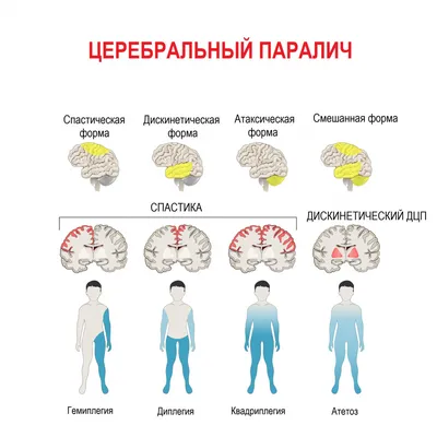 Церебральный паралич - причины появления, симптомы заболевания, диагностика  и способы лечения