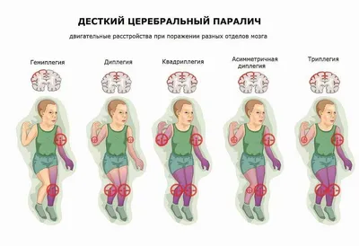 Симптомы детского церебрального паралича - Метод Козявкина