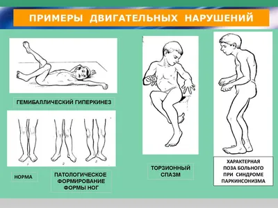 Какие особенности обучения детей с ДЦП? | Медицинская клиника \"Центр Речи\"  в Зеленограде