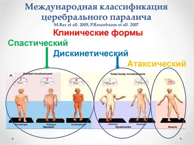 ДЦП у детей: признаки и лечение детского церебрального паралича