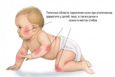 MedWeb - Первые признаки ДЦП: на что необходимо обращать внимание