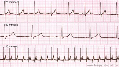 Нормальная ЭКГ: скорость и амплитуда записи