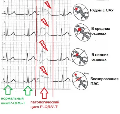 ЭКГ эктопический ритм (несинусовый ритм) ч. 2 | Пикабу