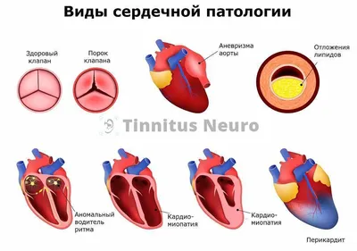 Как не пропустить тромбоэмболию легочной артерии (ТЭЛА). ЭКГ признаки ТЭЛА.  - YouTube