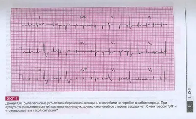 Расшифровка ЭКГ у взрослых и детей онлайн | Заказать расшифровку