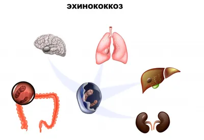 Эхинококкоз - причины появления, симптомы заболевания, диагностика и  способы лечения