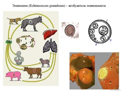 Эхинококкоз печени | Радиография