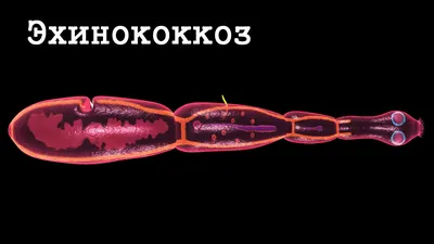 Эхинококкоз – что это за болезнь, 💉 лечение, симптомы и 🔬 диагностика на  МЕД Zoon