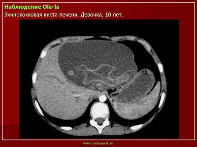 Эхинококк. Лечение - Семейная медицина и Гастроэнтерология