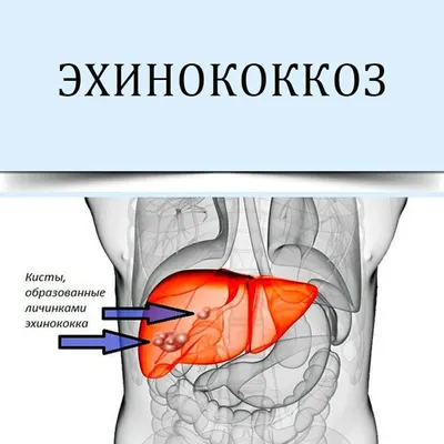 Эхинококкоз - признаки, причины, симптомы, лечение и профилактика -  iDoctor.kz