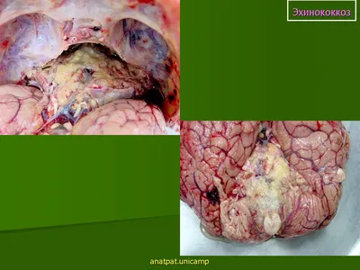 Врачи Александро-Мариинской больницы прооперировали пациента с редким  осложнением эхинококкоза — Александро-Мариинская
