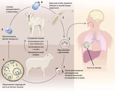 4.3. Эхинококковые поражения лёгких и средостения