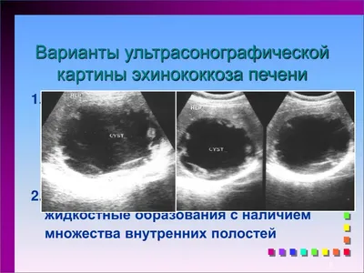 Эхинококкоз печени: роль компьютерной томографии и морфологической  диагностики состояния ткани печени – тема научной статьи по клинической  медицине читайте бесплатно текст научно-исследовательской работы в  электронной библиотеке КиберЛенинка