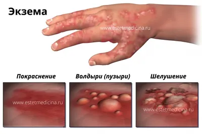 Как я пытаюсь победить экзему | Пикабу