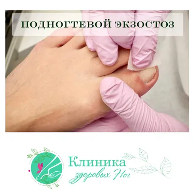 Экзостоз бедренной кости - симптомы, диагностика, лечение в Москве ЦИТО