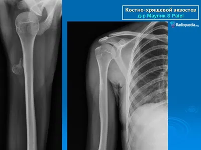 Экзостоз На Десне 9 Причин Как Убрать ЛюмиДент