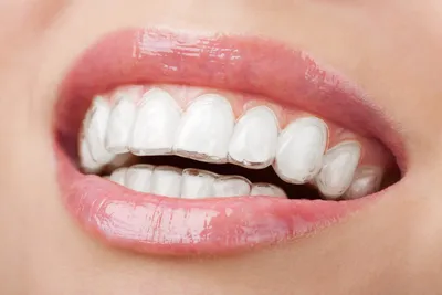 Элайнеры Invisalign | Стоматология в Кудрово